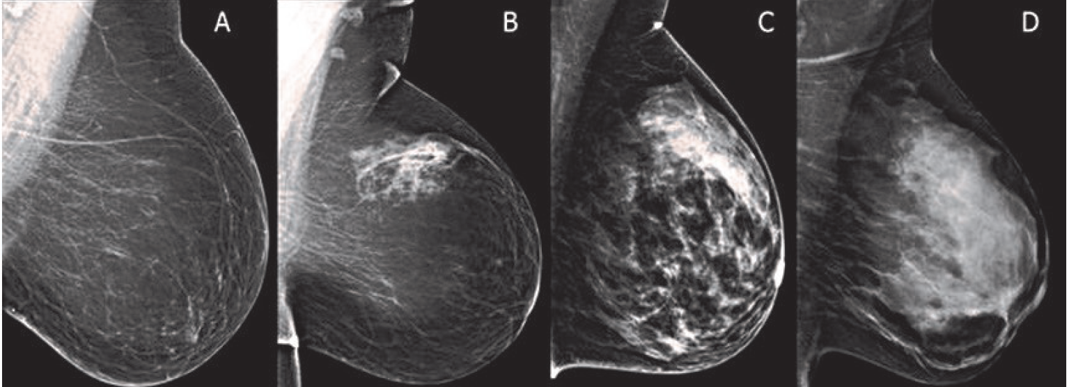 fibroglandular_density_levels.png