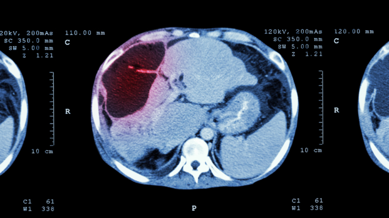 Hemangioma Liver Lesions