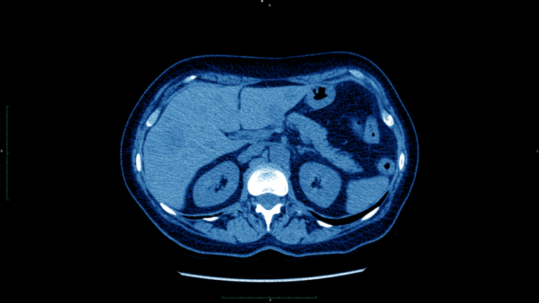 Focal Nodular Hyperplasia Liver Lesions