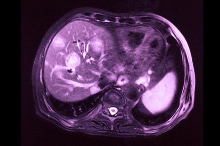 Liver Metastases (Hepatic Metastases)