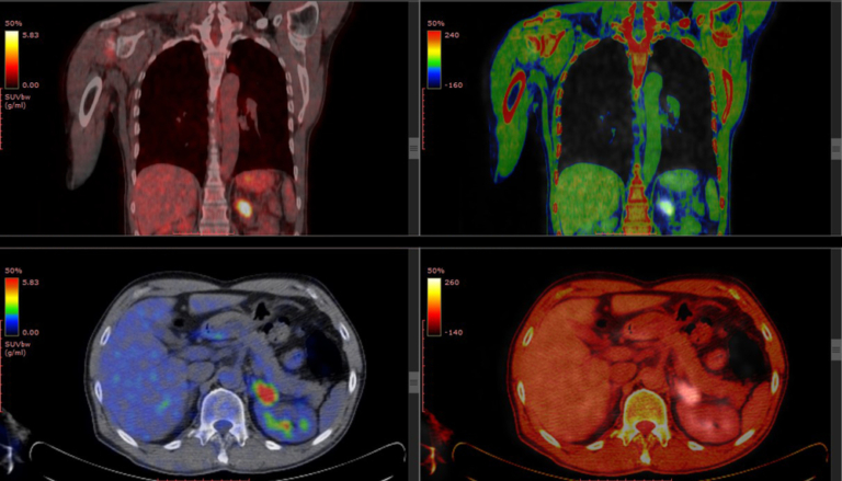 Understanding Your FDG PET Scan