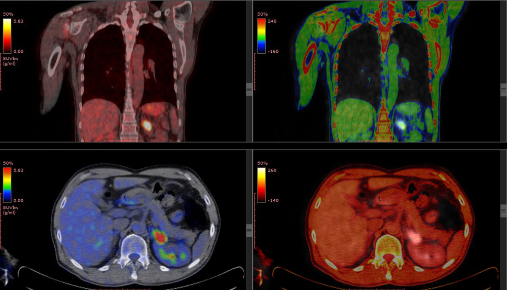 Understanding Your FDG PET Scan understanding-your-fdg-pet-scan