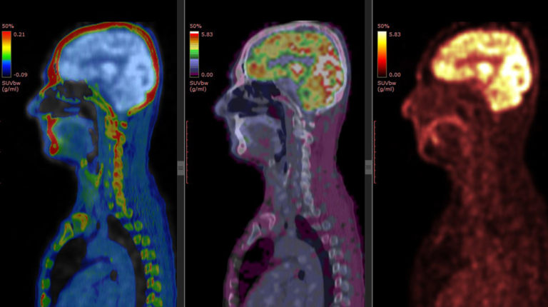 Nuclear Medicine Specialists Reveal How Providers Can Overcome Workflow Challenges in PET Imaging