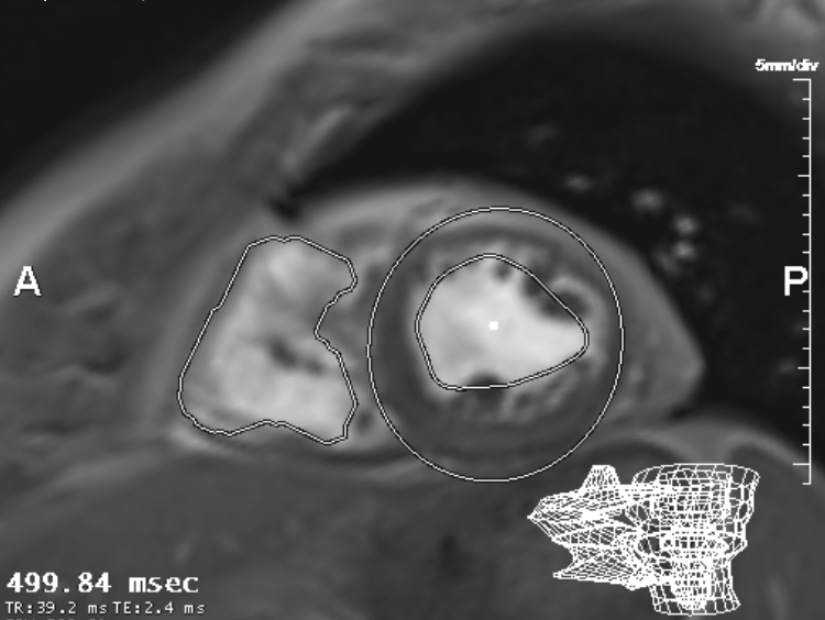 Interview with Dr. Lorenz: The Latest Developments in Cardiac MRI